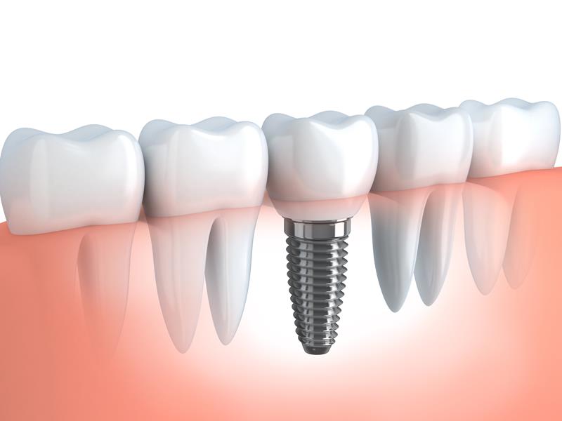 Dental Implants  Schererville, IN, 