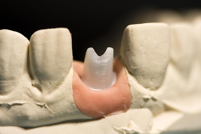 Implant Restoration  Schererville, IN, 