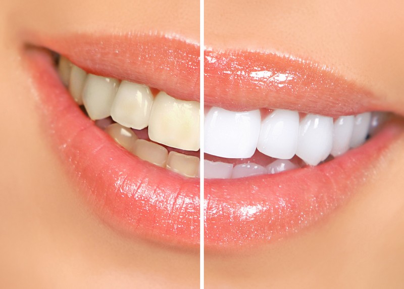 Teeth Whitening Schererville, IN,