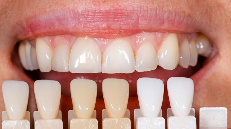 Veneers  Schererville, IN, 
